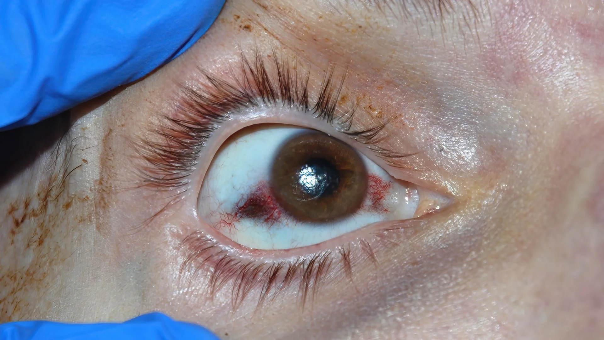 How Much Does Pterygium Surgery Cost?