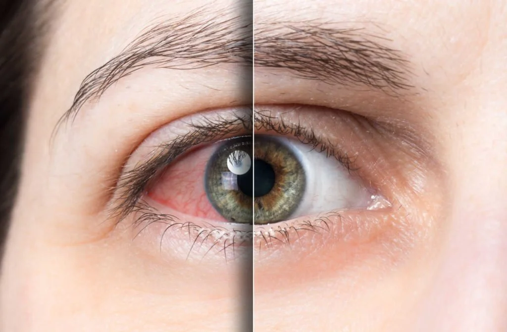 Preventing Red Eye: Best Practices for Safe Lens Use