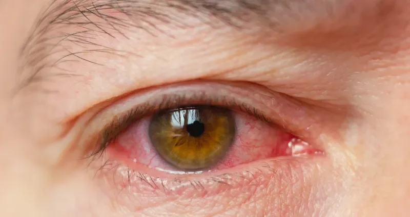 Red Eye After Contact Lens Wear: Causes, Risks, and Safe Solutions