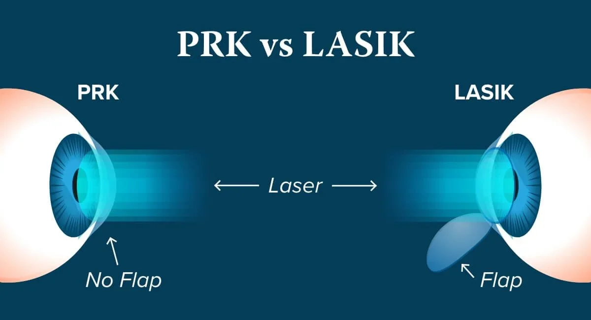 PRK vs LASIK Eye Surgery