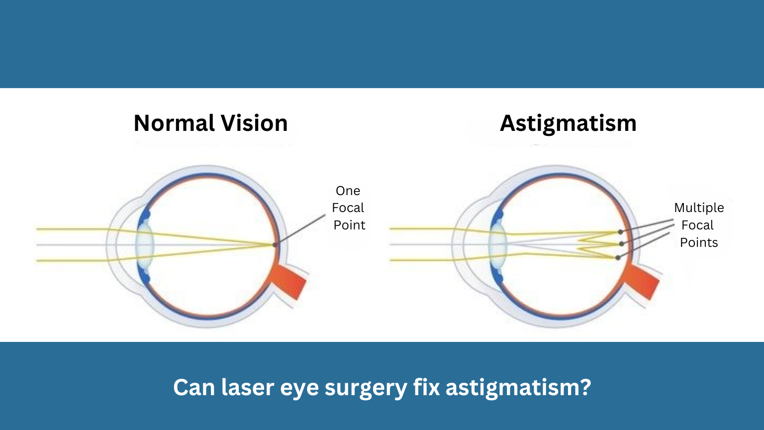 Laser Eye Surgery For Astigmatism Better Than Glasses DR BRENDAN Laser Eye Surgery For Astigmatism Better Than Glasses DR BRENDAN