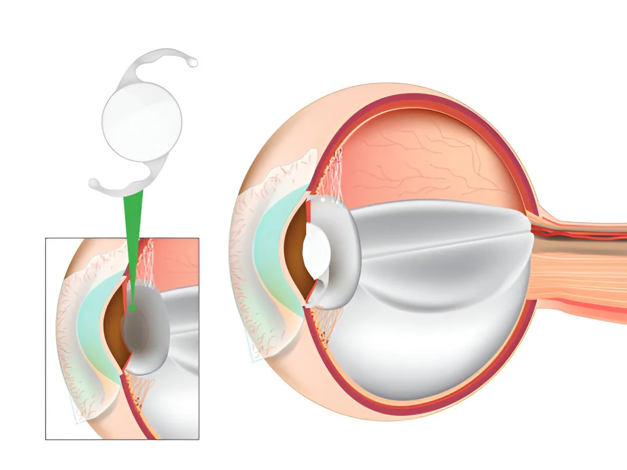 Vision Correction: Choosing the Right Lens