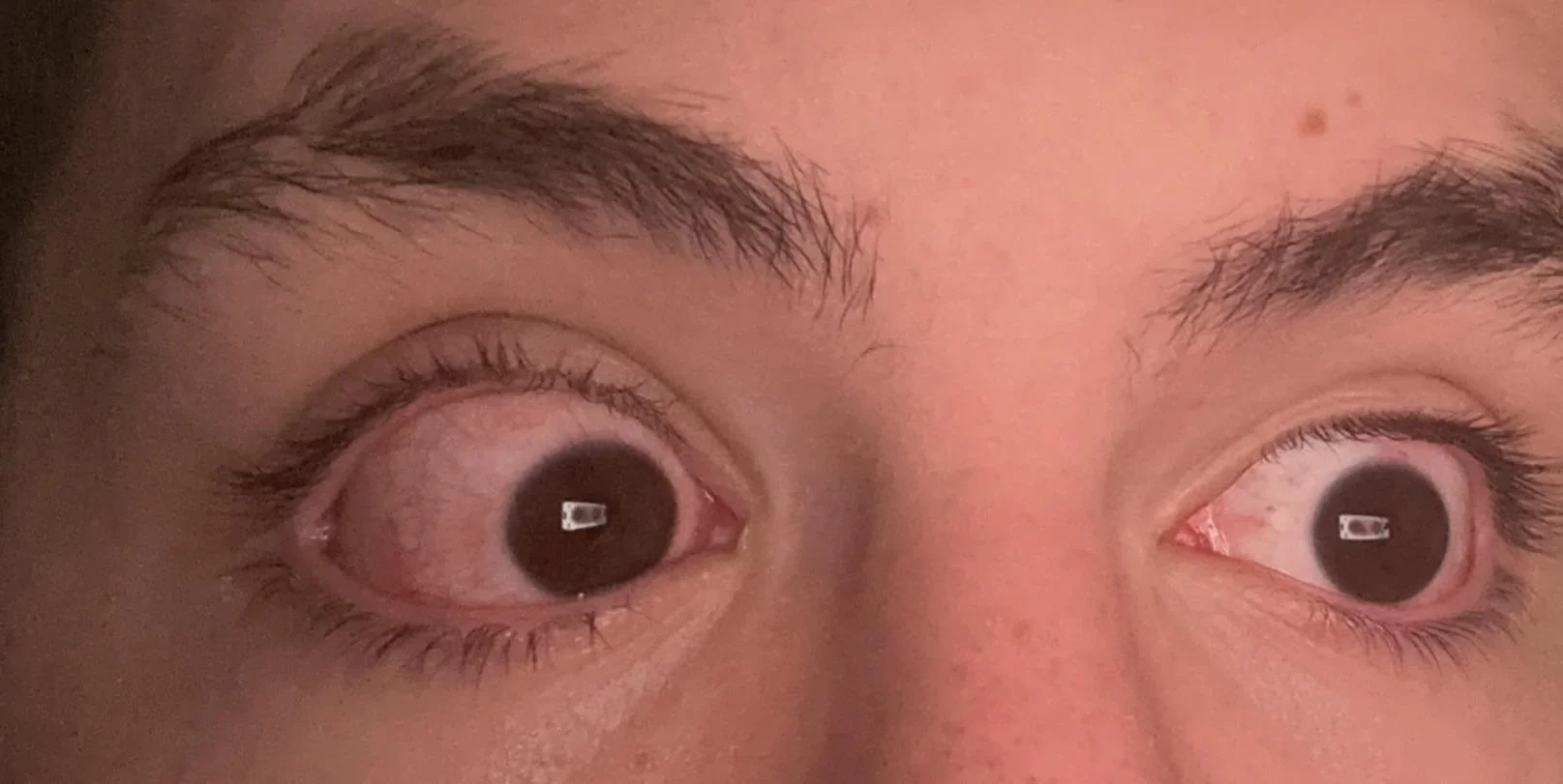 When to Stop Wearing Lenses and Seek Help