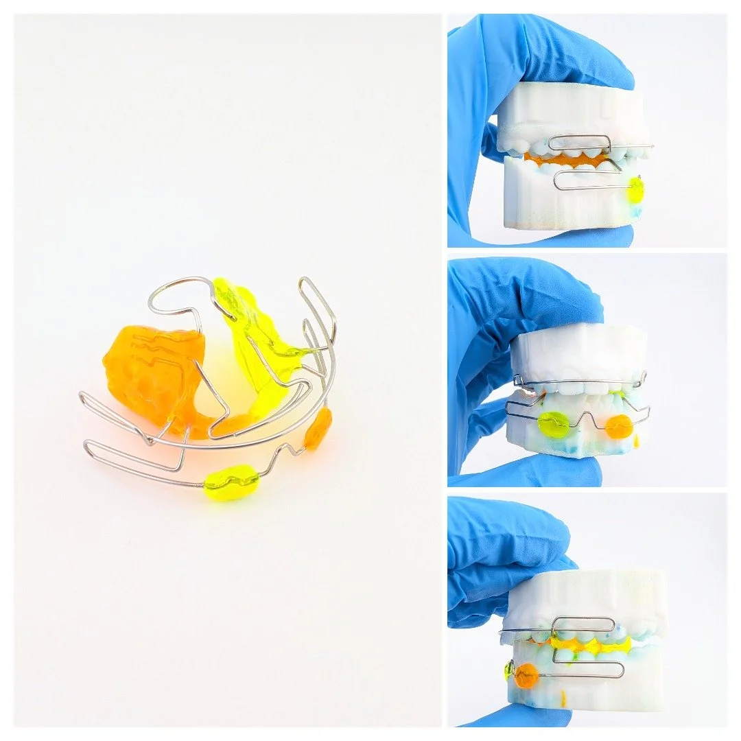 Klammt ✦ Activador el&aacute;stico abierto 🦷
&iquest;Sabes qu&eacute; es el Klammt? Un aparato funcional removible que trabaja con el propio crecimiento del paciente para corregir la relaci&oacute;n entre los maxilares &mdash; sin brackets, sin fuer