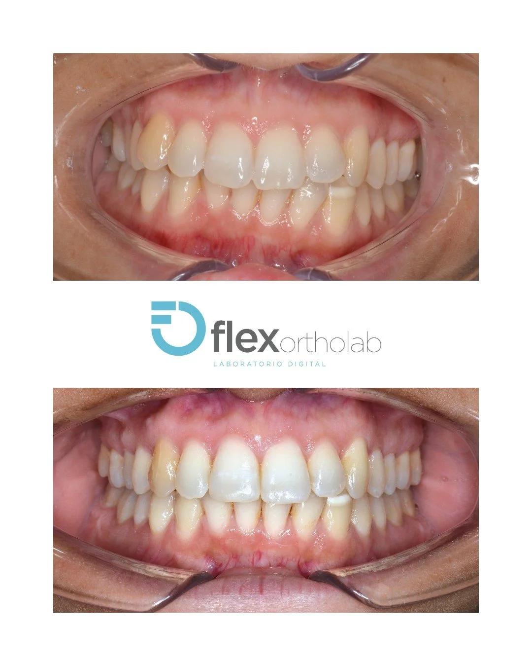 🤝 Cuando la experiencia cl&iacute;nica se encuentra con la precisi&oacute;n t&eacute;cnica
Gracias a la Dra. Xenia Garc&iacute;a por confiar en nuestros alineadores Flexortholab para este tratamiento. El resultado habla por s&iacute; solo.
Detr&aacu