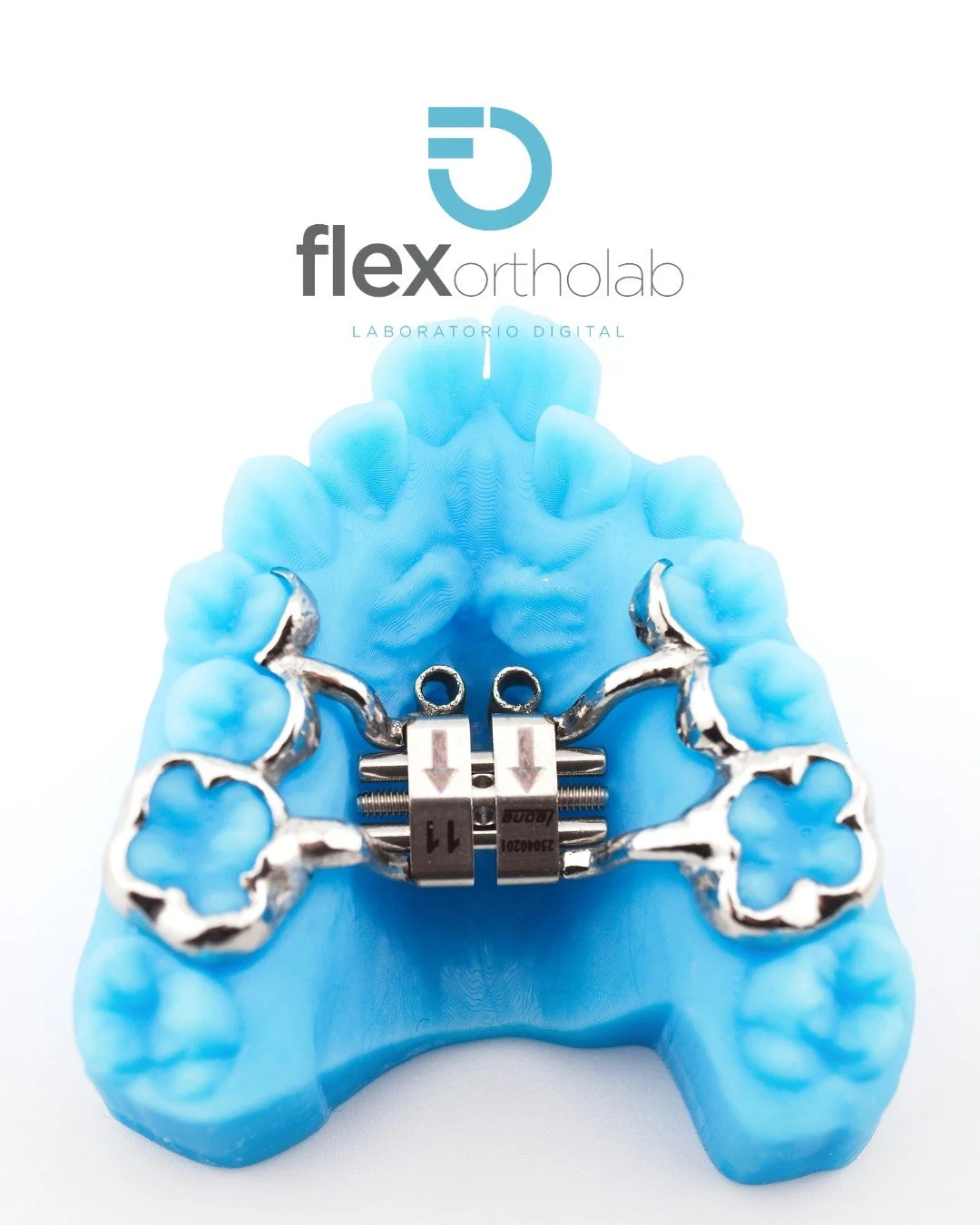 En FlexOrthoLab seguimos apostando por aparatolog&iacute;a de alta precisi&oacute;n para casos de expansi&oacute;n maxilar en ortodoncia.
Este disyuntor esquel&eacute;tico integra dos microtornillos para una anclaje estable y un tornillo de expansi&o