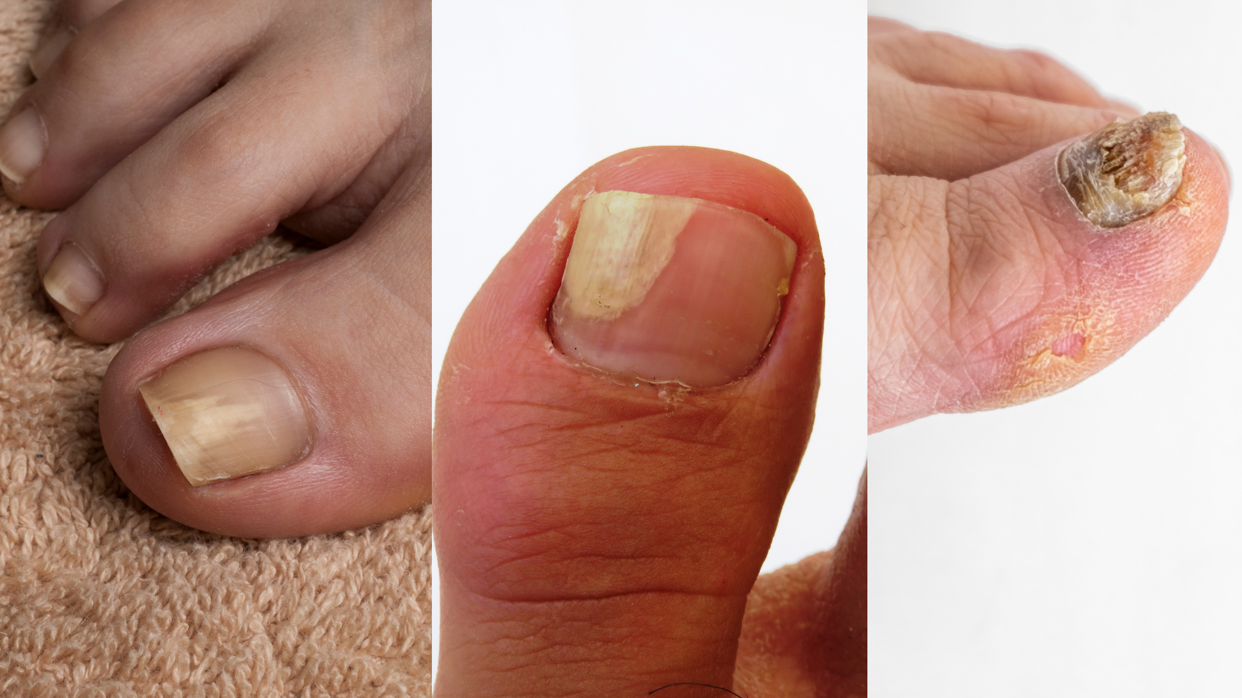 COMMENT RECONNAÎTRE UNE MYCOSE DES ONGLES ?