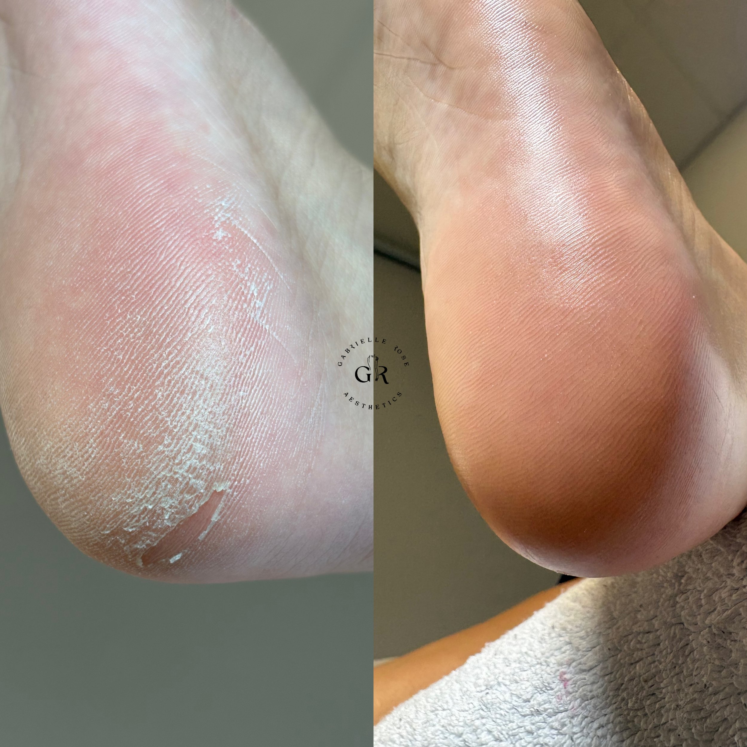 POURQUOI A-T-ON DES CALLOSITÉS AUX PIEDS ? 