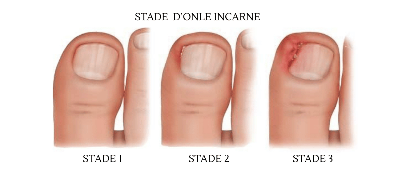 Ongle incarné