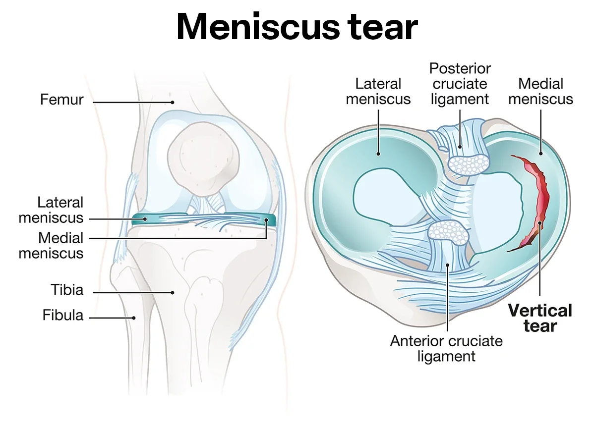 Meniscus Tears: Do You Really Need Surgery?