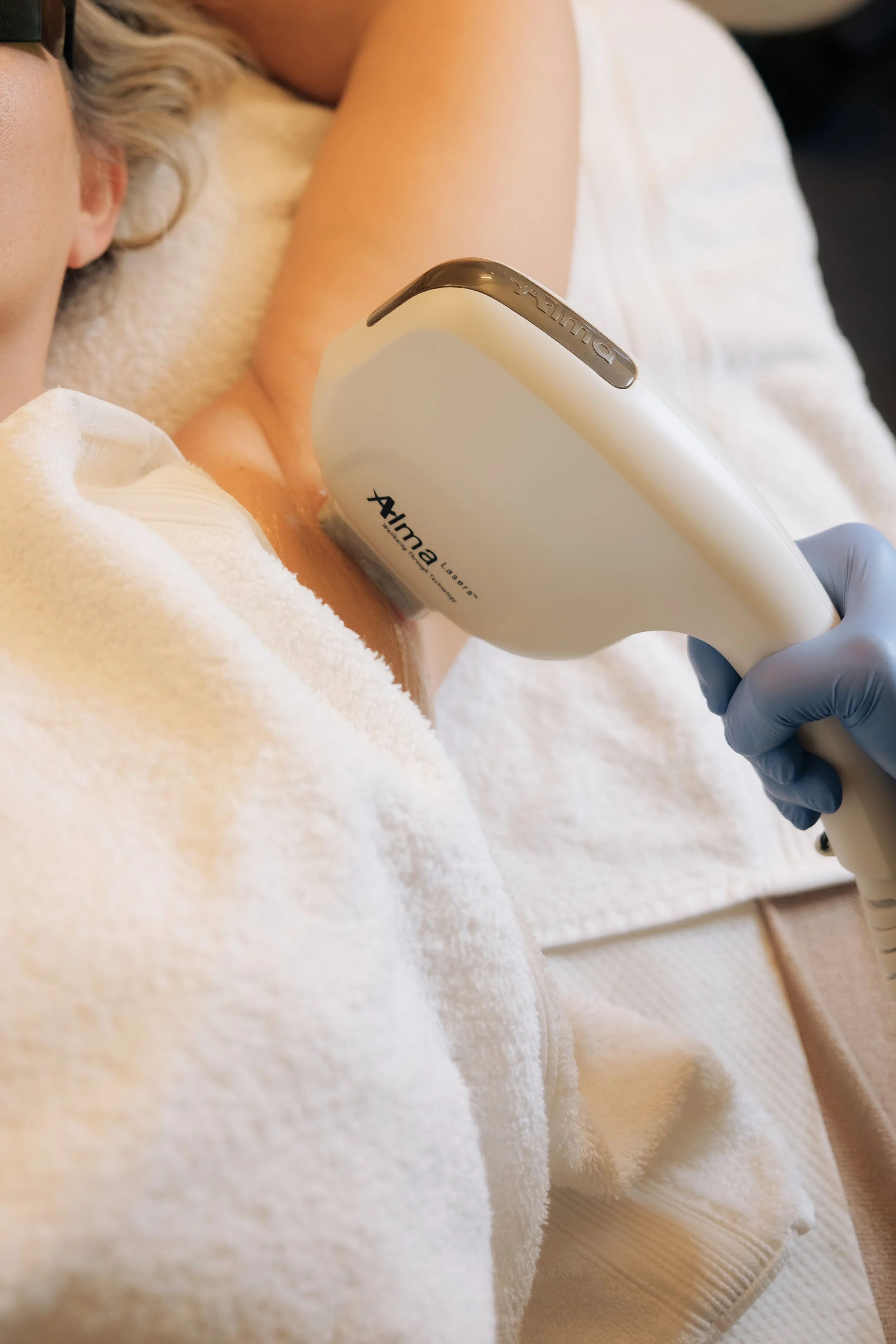 Eine Laserhaarentfernung im Achsel-Bereich einer Frau