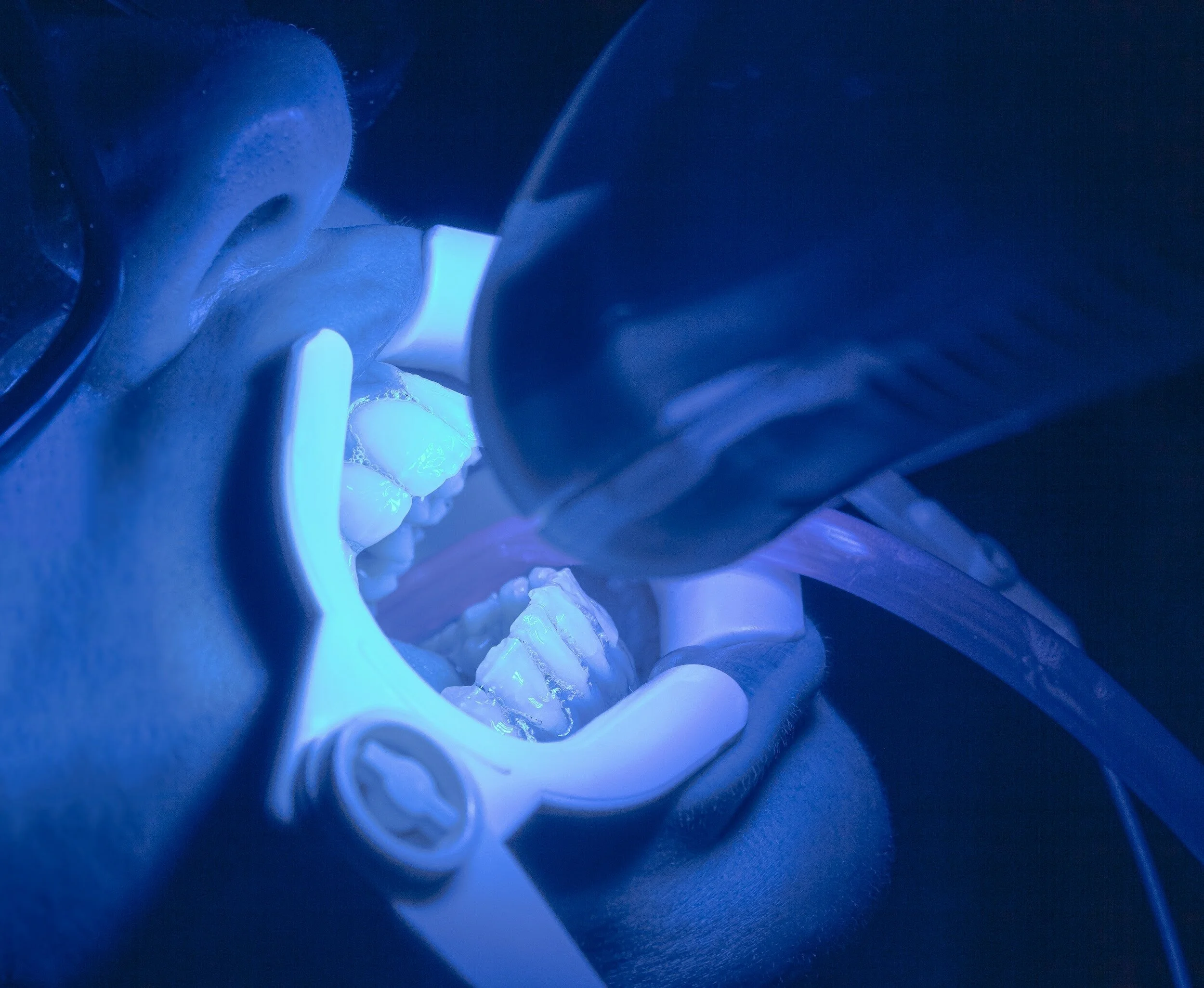Una persona si sottopone a un trattamento di sbiancamento dentale con luce blu in una clinica dentale.