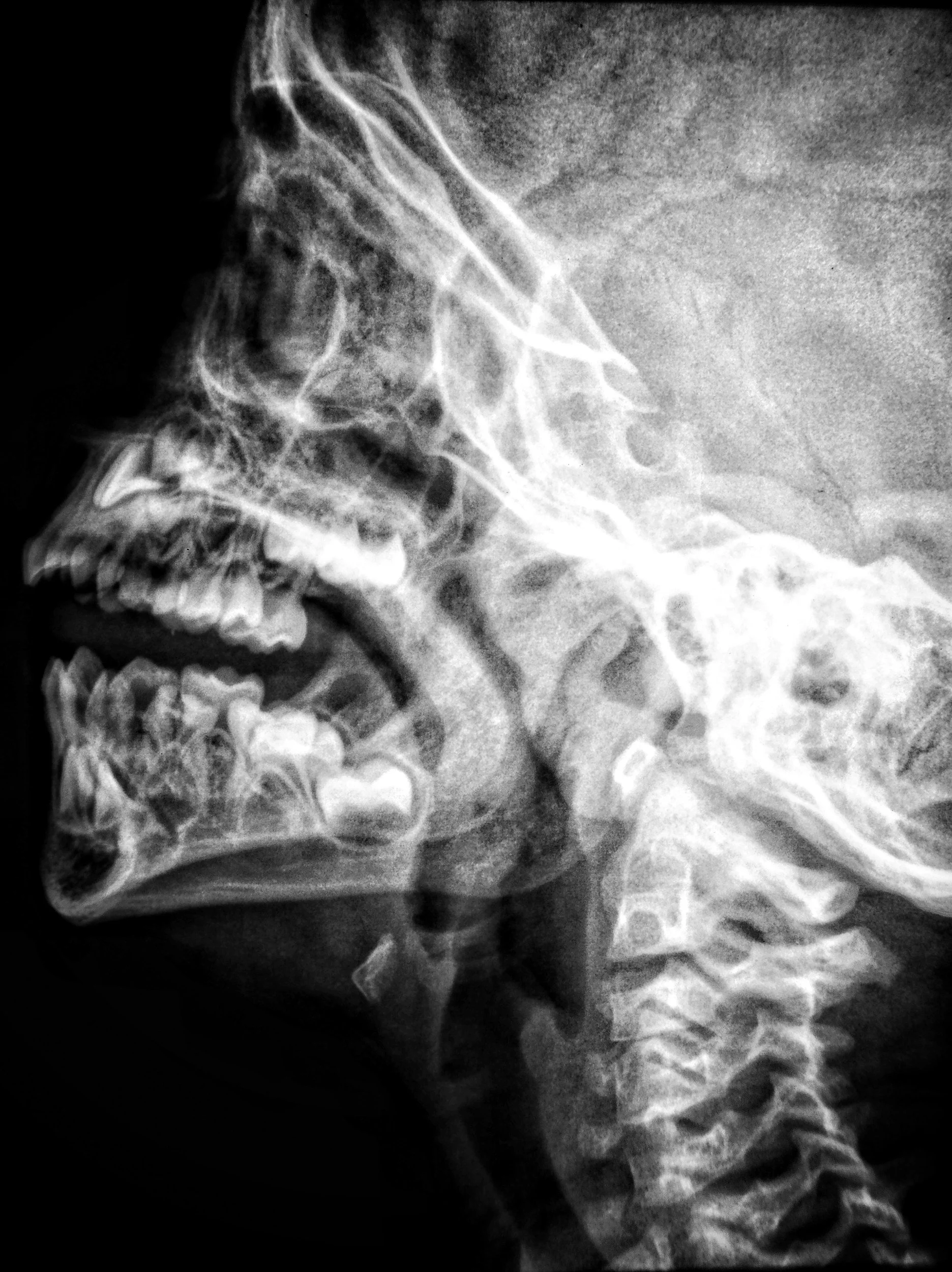 Radiografia di testa umana in profilo, che mostra ossa del cranio, mascella e colonna vertebrale cervicale.