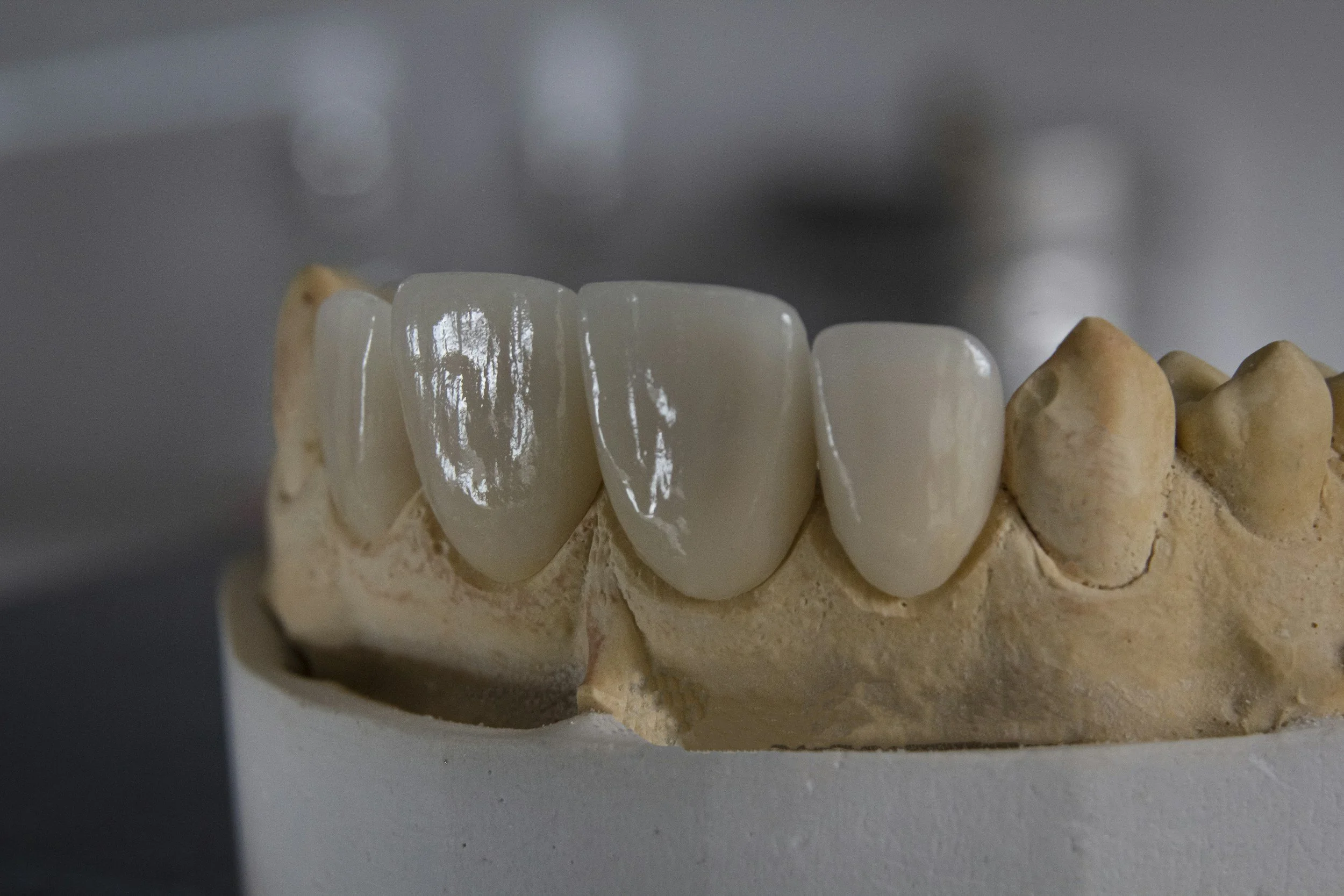 Modello di dentina con impianto dentale e faccette estetiche