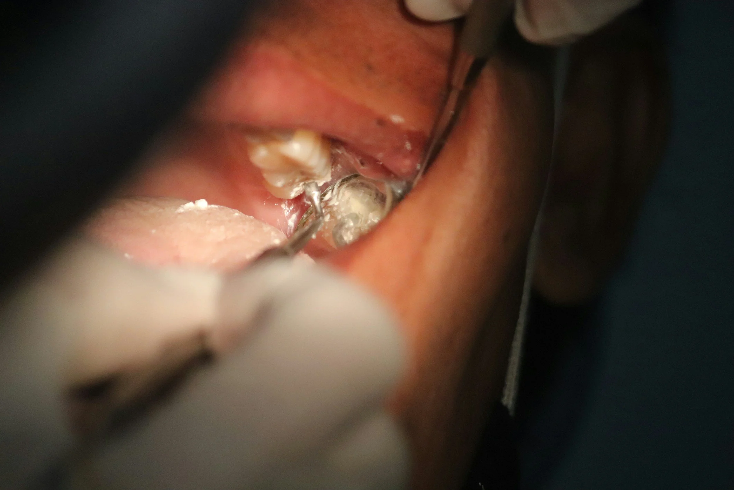 Procedura odontoiatrica con strumenti medici che lavano i denti di un paziente.