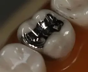 Dente con amalgame dentale metallici