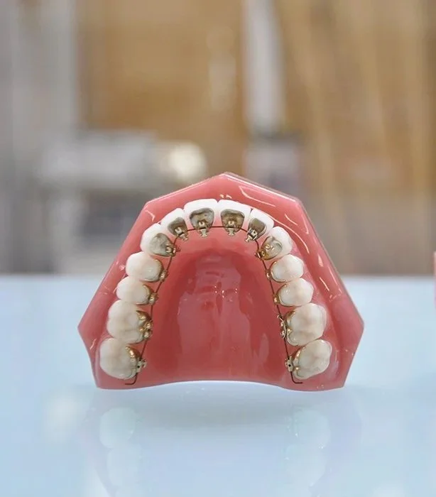 Modello dentale con apparecchio ortodontico a brackets metallici su una dentatura superiore in plastica rosa.