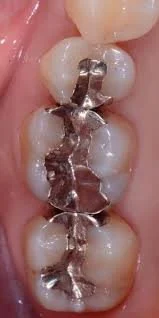 Denti posteriori con otturazioni in amalgama