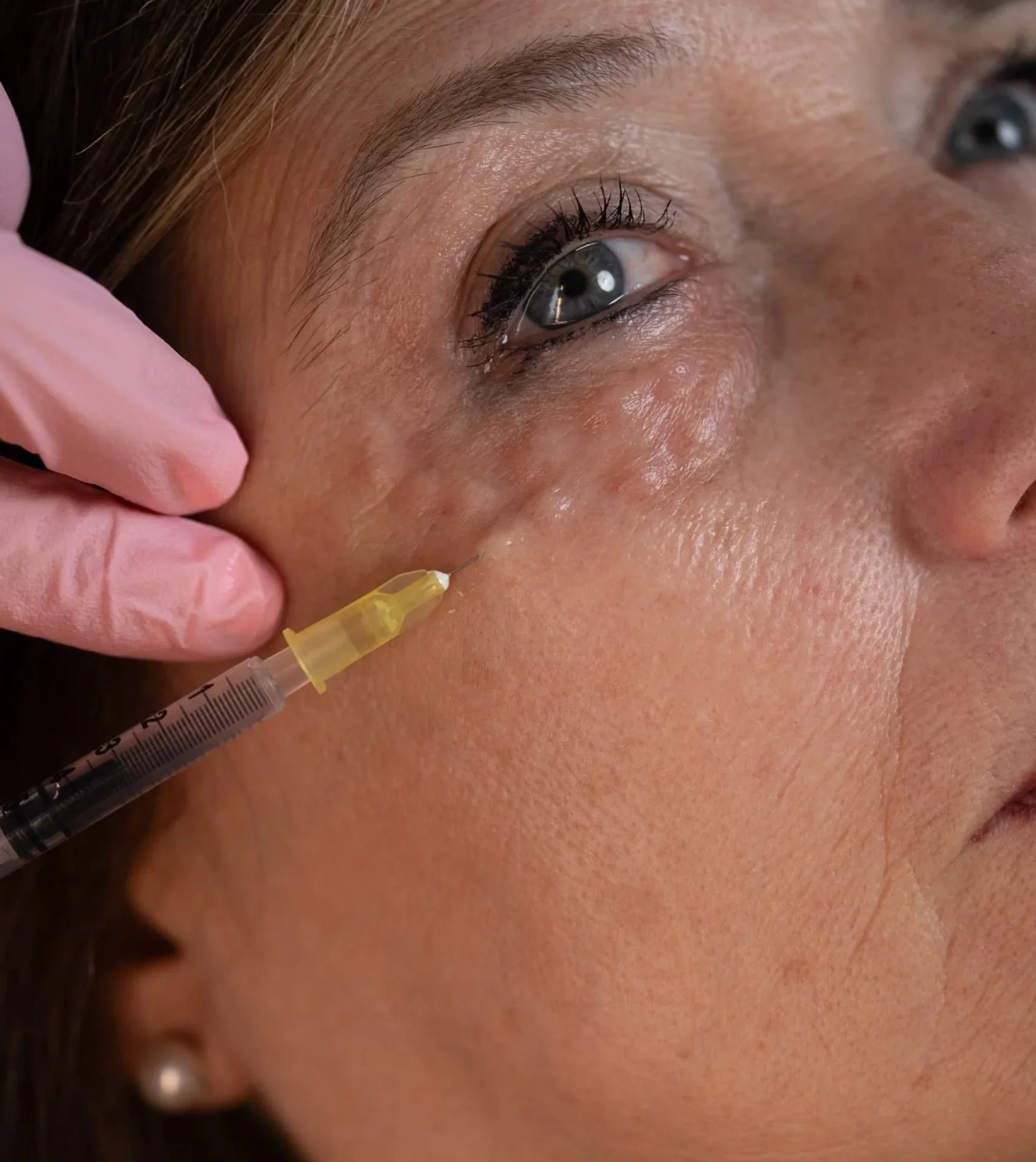 Una donna riceve un'iniezione di Botox sotto l'occhio da un medico mentre si trova in posizione distesa.