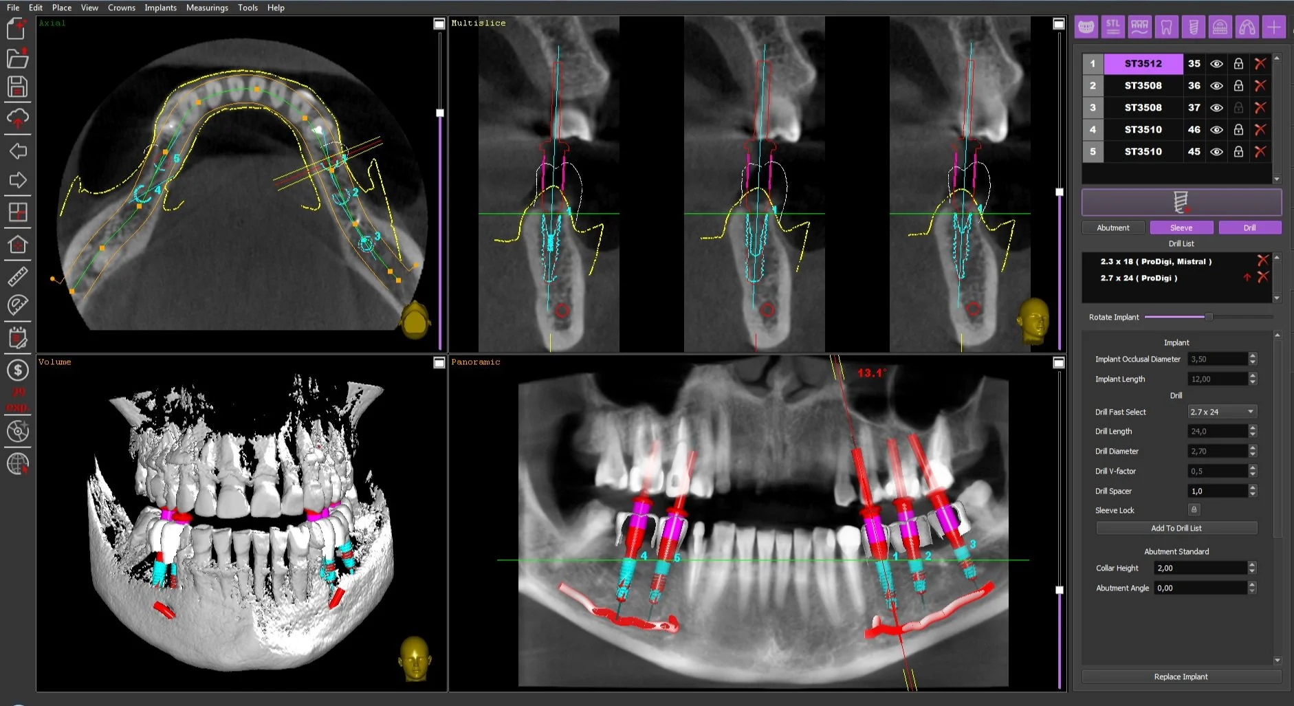 Ritratto di una schermata di software di pianificazione implantare dentale, che mostra scansioni di radiografie odontoiatriche, modelli 3D e piani di impianto dentale con varie impostazioni di posizionamento e dimensioni degli impianti.