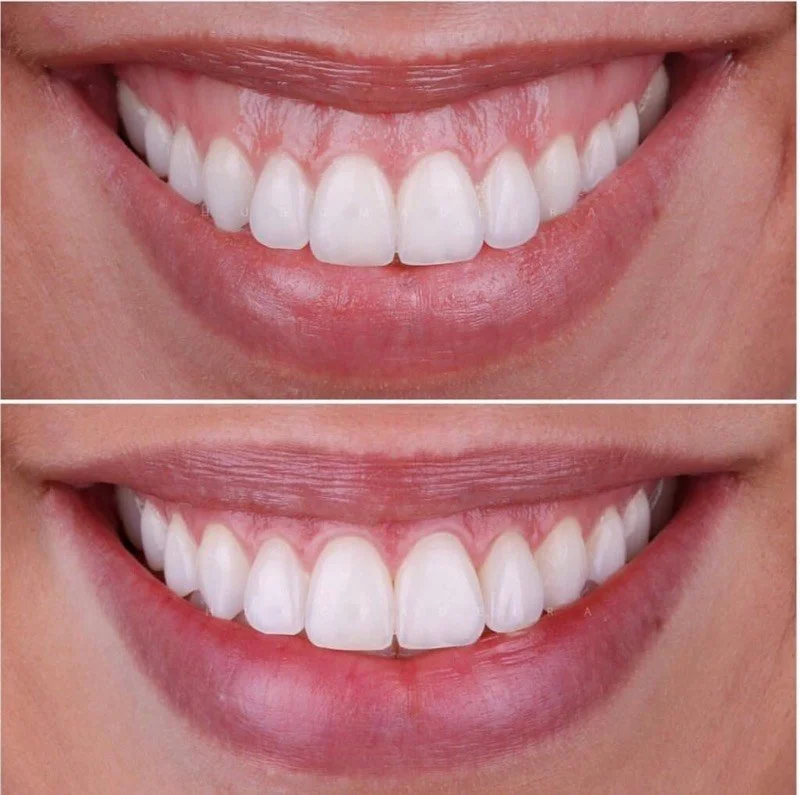 Sorriso con denti visibilmente più bianchi e dentatura più uniforme