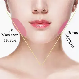 Rilievo delle aree muscolare masseterica e l'iniezione di Botox sul volto