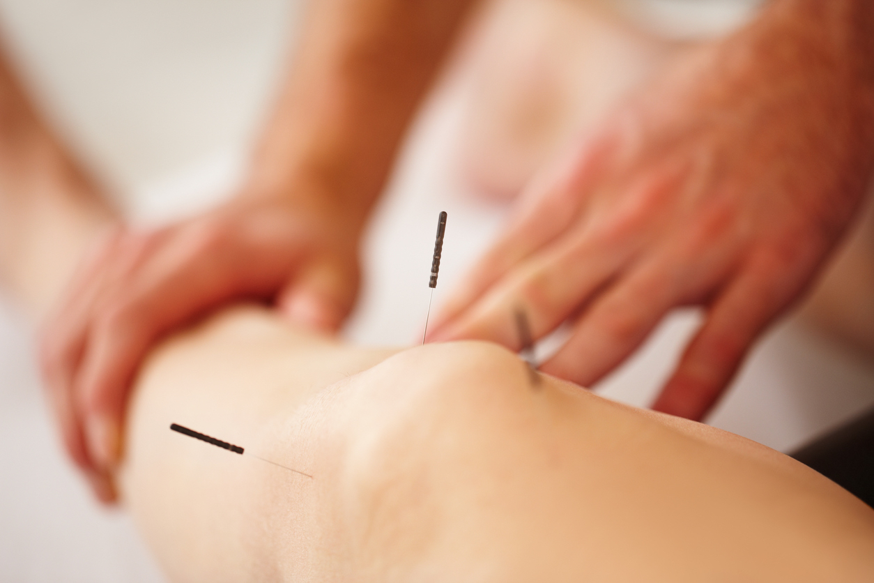 Understanding Dry Needling: A Targeted Approach to Pain Relief