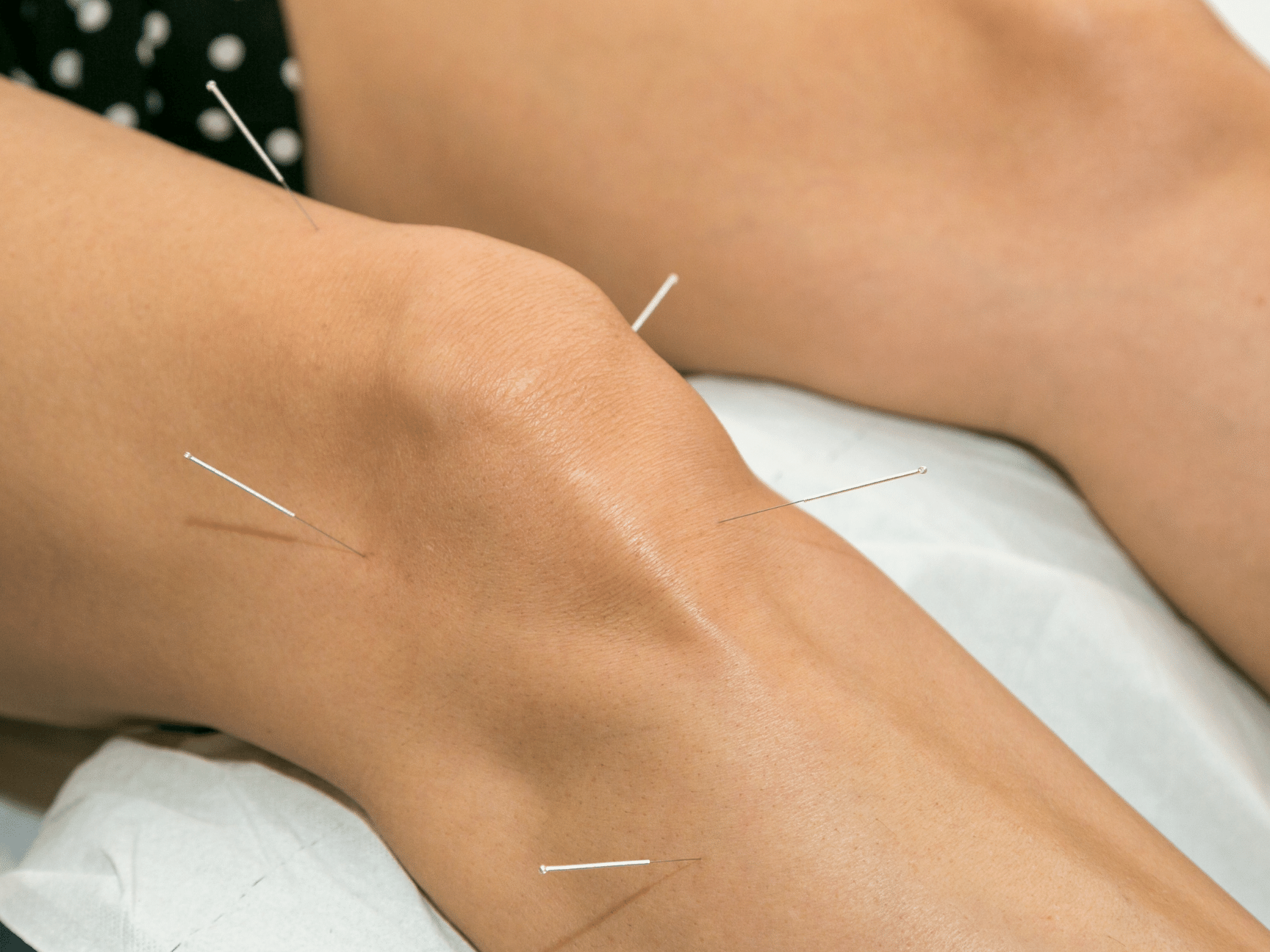 Shockwave Therapy & Dry Needling: How to Know if They’re Right for You