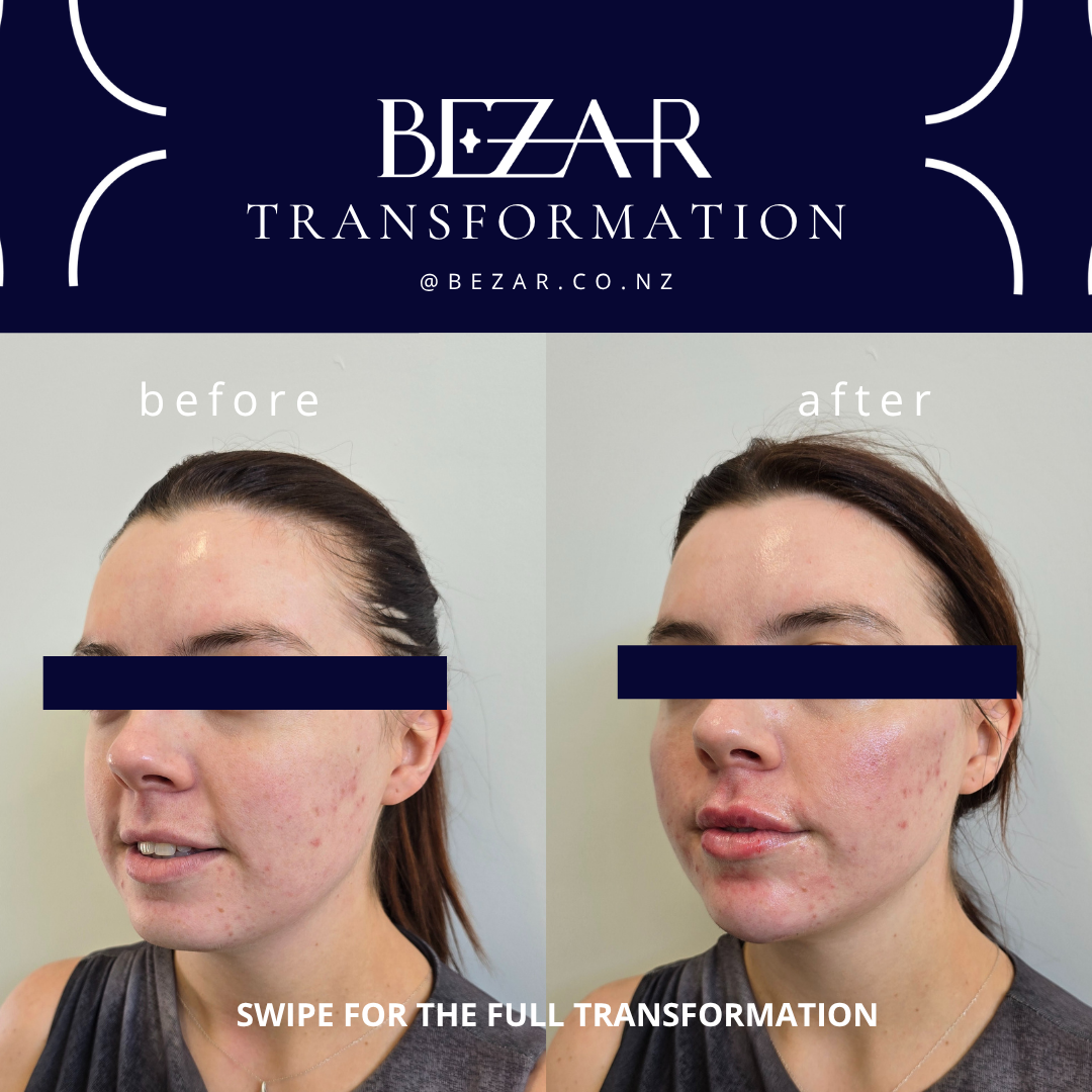 Before and after hyaluronic acid dermal filler treatment showing changes in lip volume and contour at Bezar
