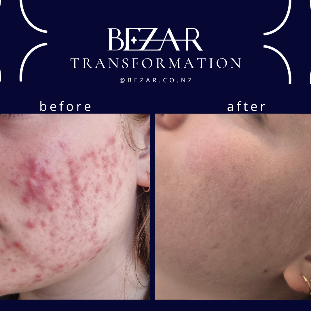Before and after SkinPen microneedling showing changes in skin texture at Bezar, Blenheim