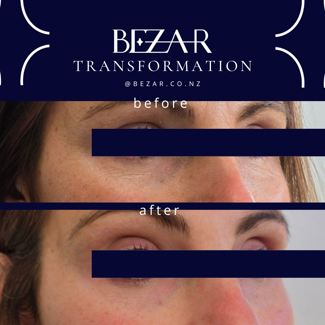Before and after Radiesse treatment showing changes in facial contours at Bezar, Marlborough