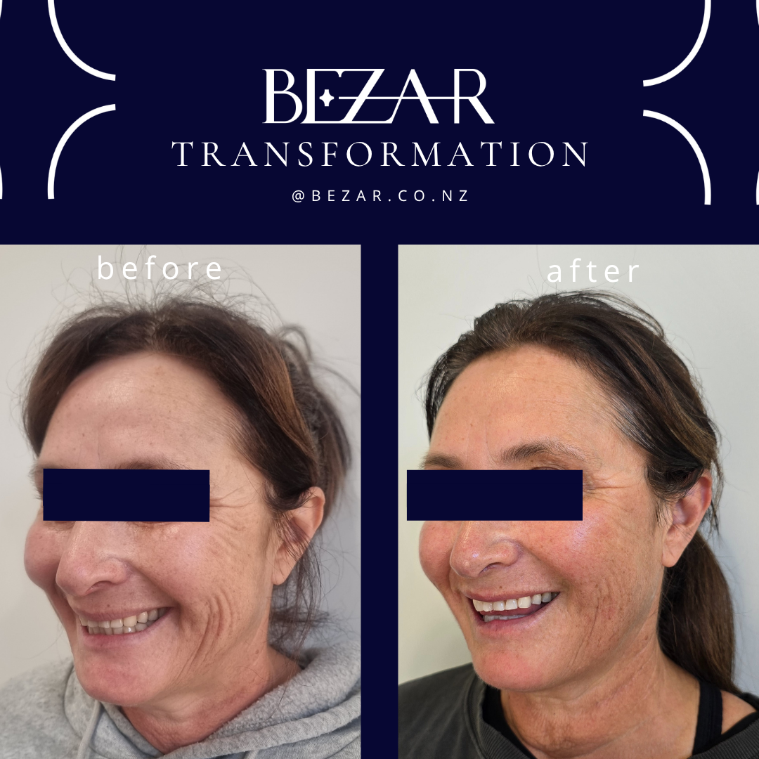 Sunekos® before and after skin rejuvenation treatment at Bezar in Blenheim, Marlborough, targeting skin quality, fine lines and elasticity.