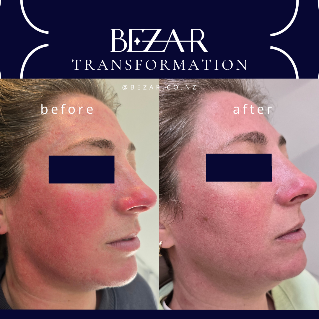 Biojuve before and after Bezar Blenheim