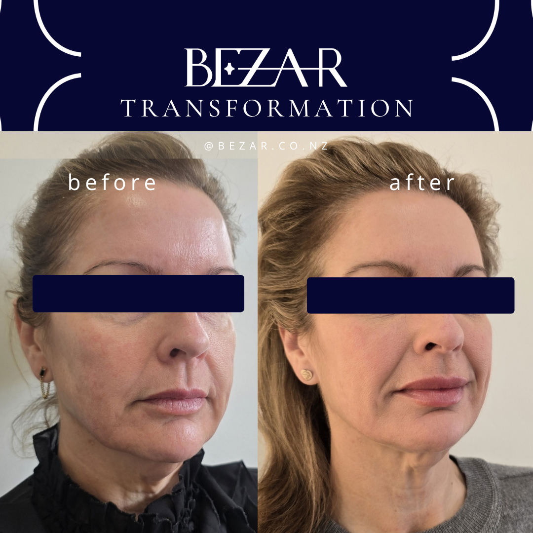 Before and after Radiesse treatment showing changes in facial contours at Bezar, Marlborough
