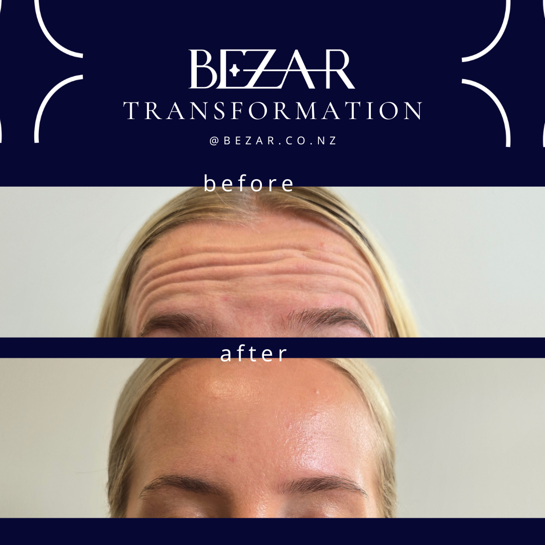 Before and after anti-wrinkle injections showing changes in forehead expression lines at Bezar, Blenheim