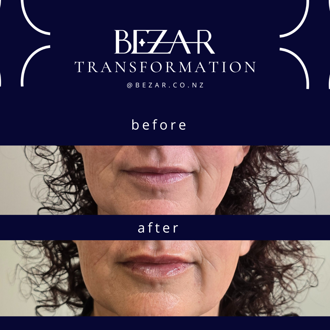 Before and after hyaluronic acid dermal filler treatment showing changes in lip volume and contour at Bezar