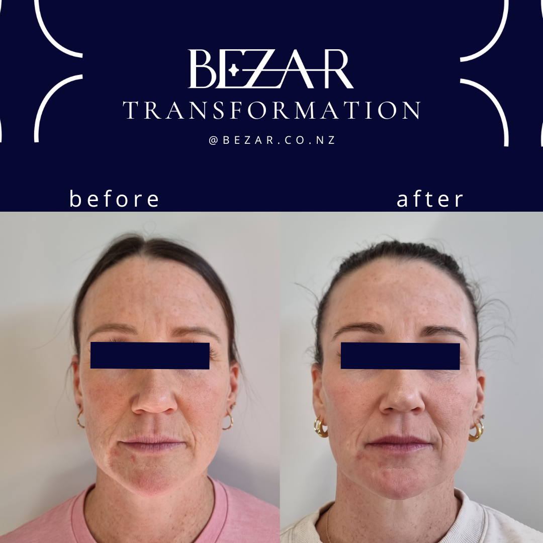 Before and after Profhilo treatment showing changes in skin appearance at Bezar