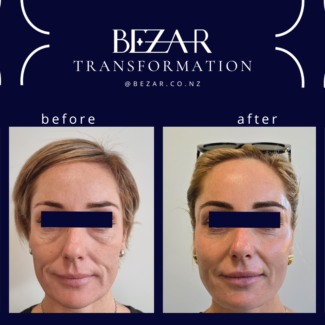 Before and after Radiesse treatment showing changes in facial contours at Bezar, Marlborough