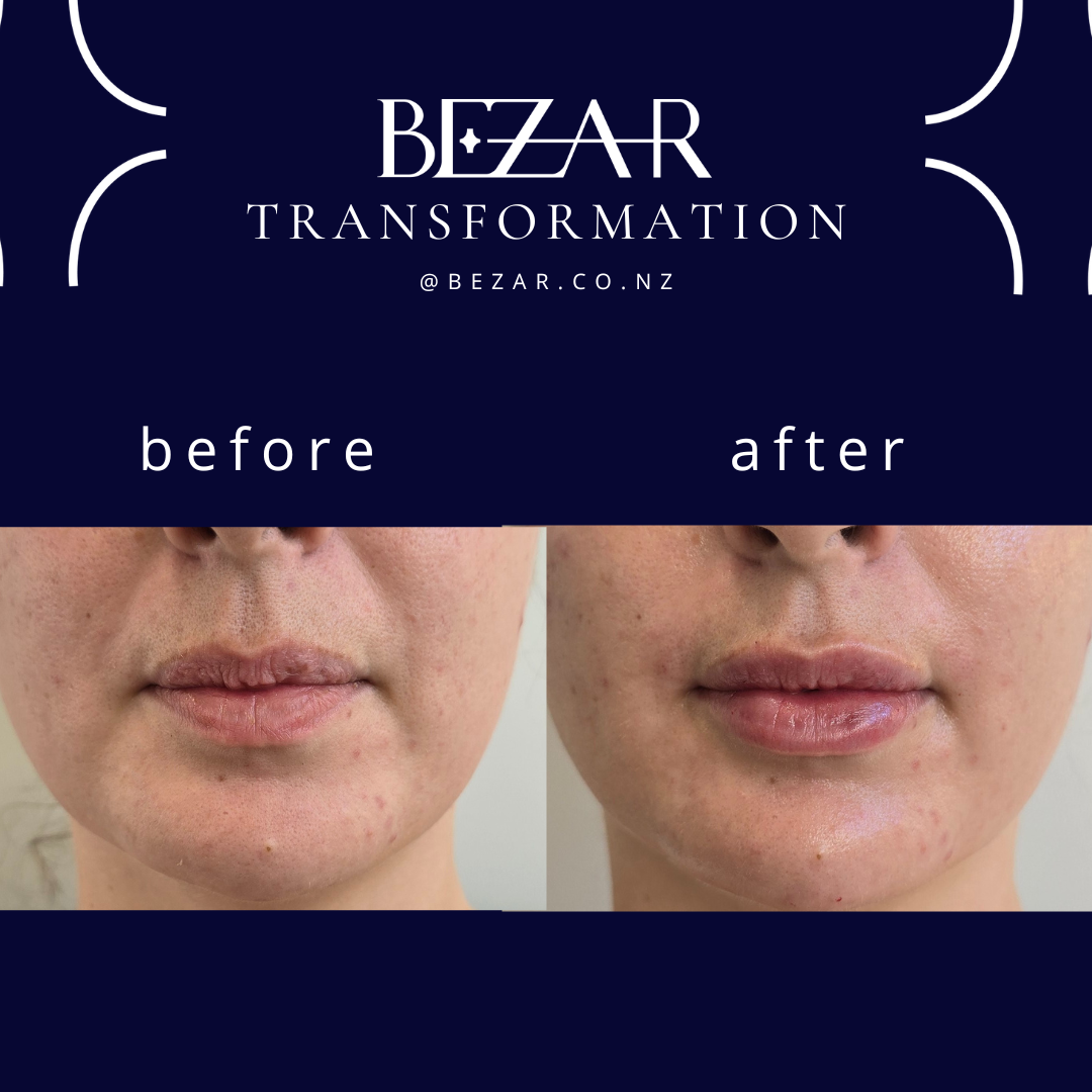 Before and after hyaluronic acid dermal filler treatment showing changes in lip volume and contour at Bezar