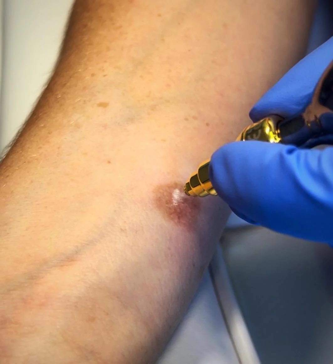 A person receiving a skin injection with a gold-colored syringe, wearing blue gloves, on an arm with visible hair and a red bump.