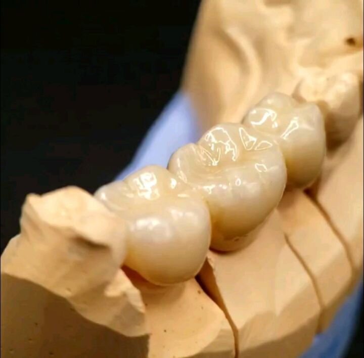 A 3-unit Monolithic Zirconia bridge, for a patient in Dublin 5.