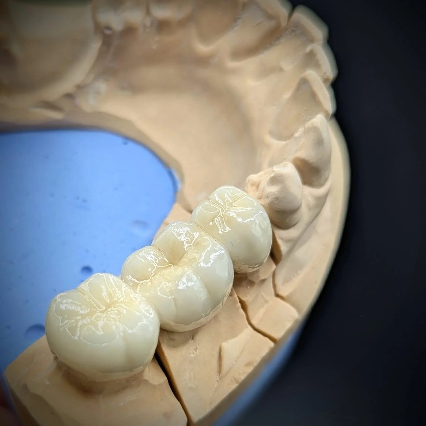 A 3-unit PFM posterior bridge, for a client in Limerick.