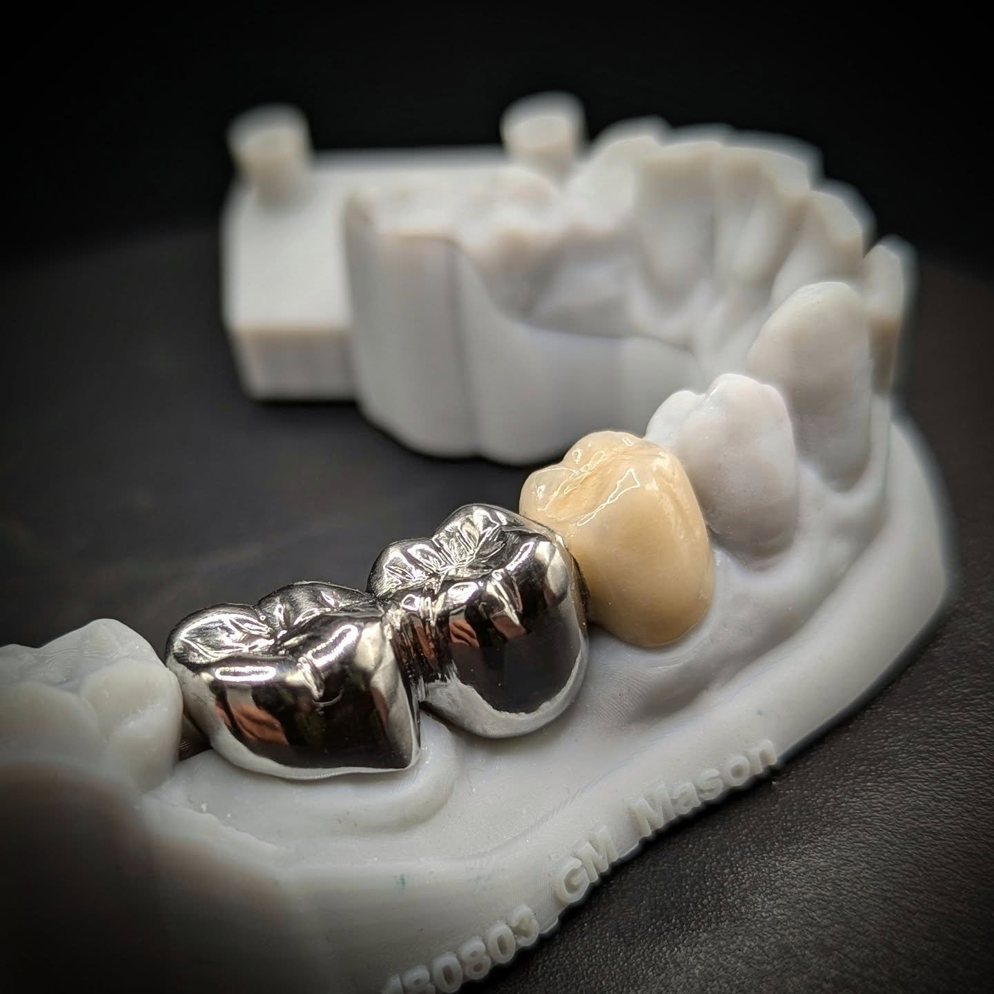 A 3-unit PFZ bridge, with a pair of striking all-metal units, creating the effect that the patient wanted.