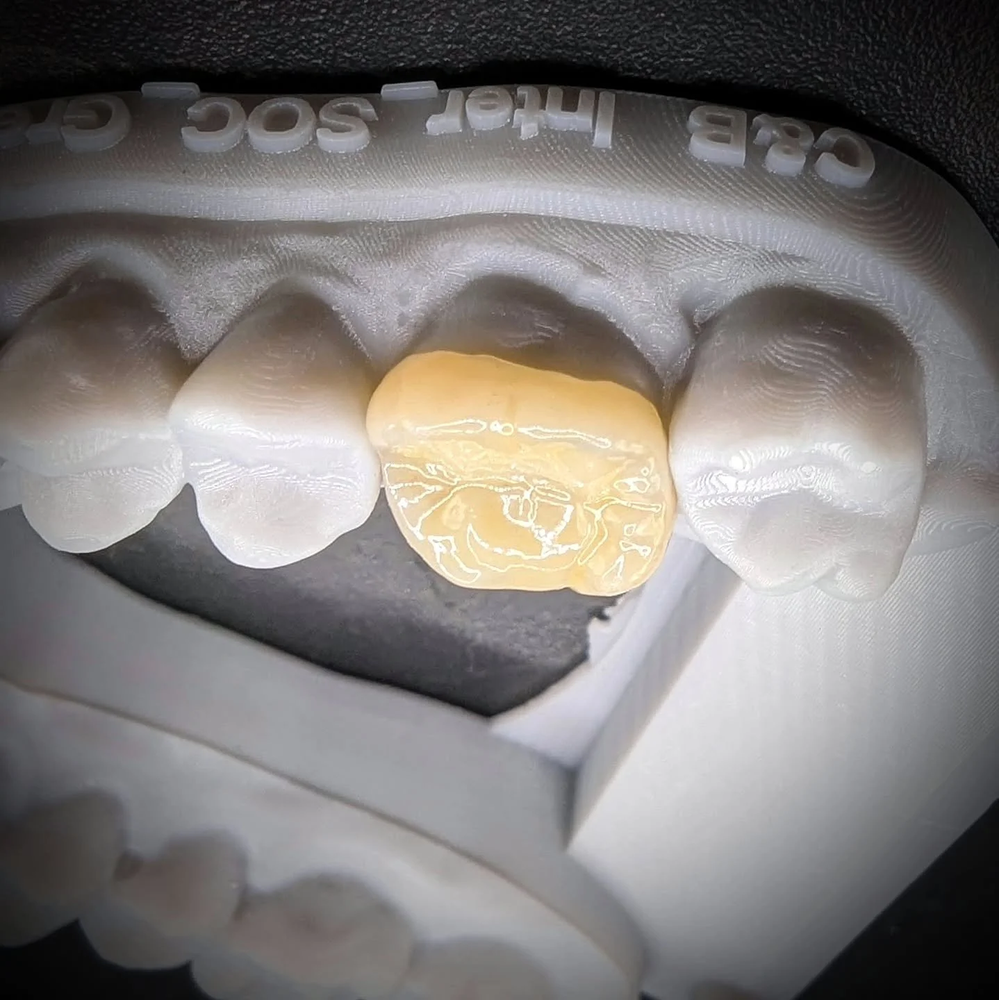 An e.Max porcelain onlay, for a client in Mullingar.