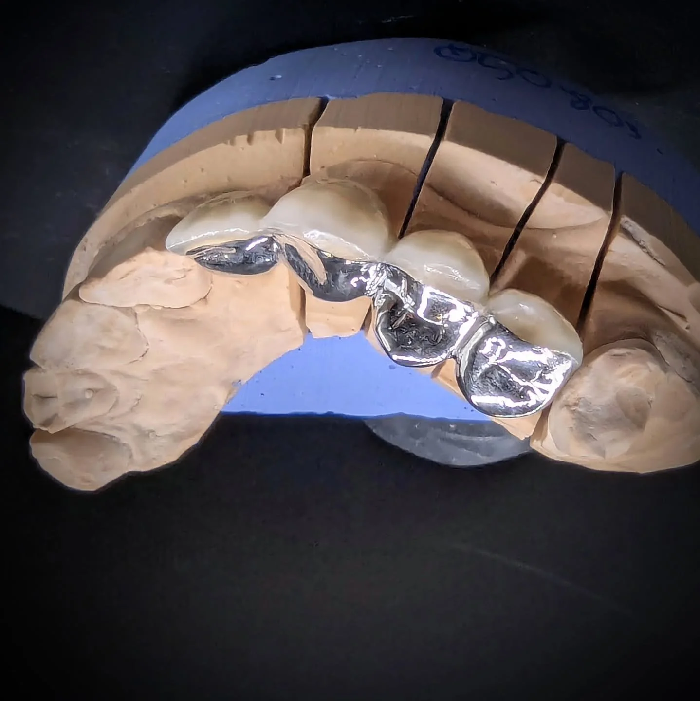 A 4-unit PFM bridge, for a patient in Cork, with metal coverage in the areas impacted by bruise.
