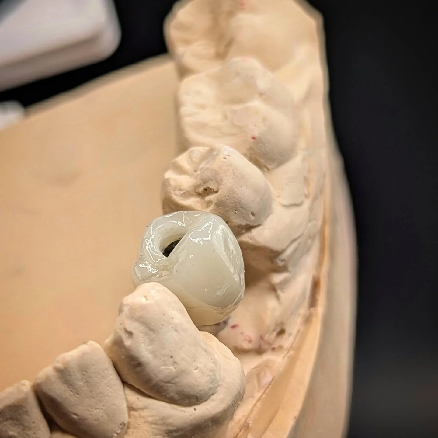 A screw-retained PFZ crown, in the lower left first premolar position, for a patient in Cork.