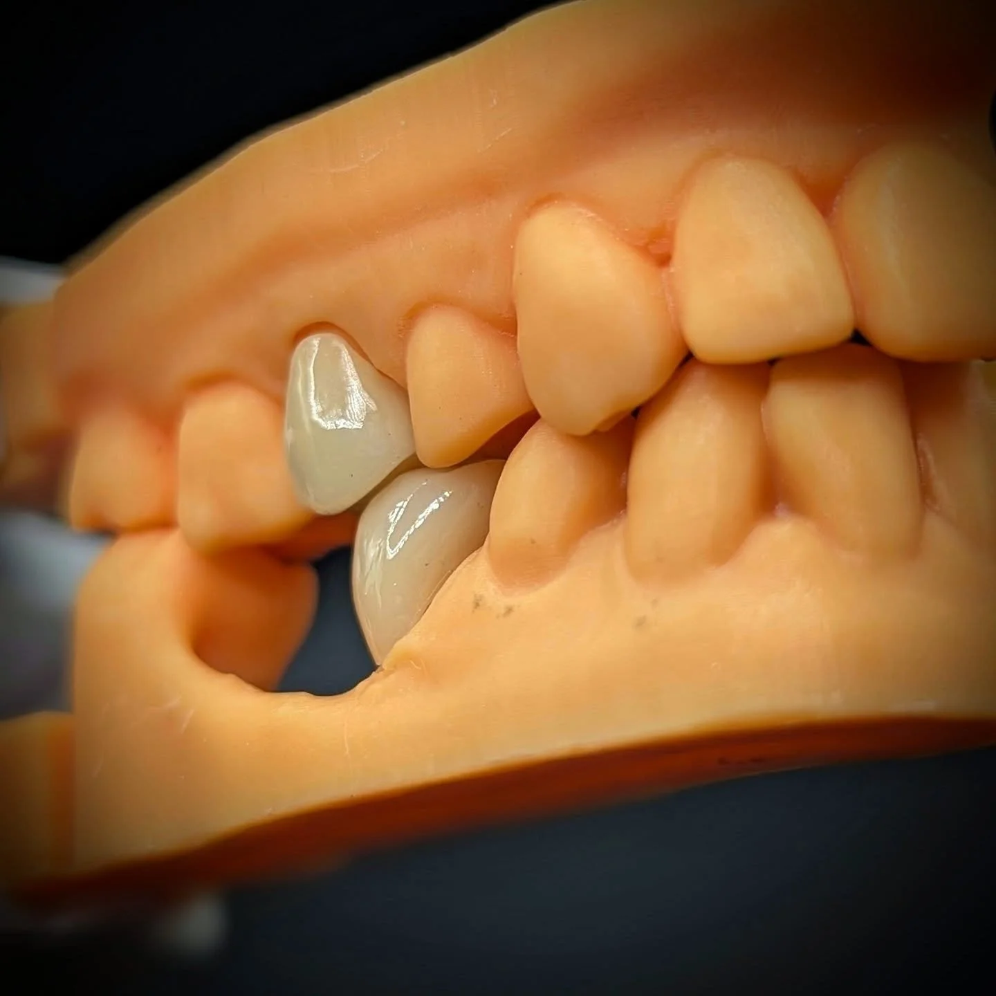 A pair of monolithic zirconia crowns, with layered translucency, for maximum strength and aesthetics.
