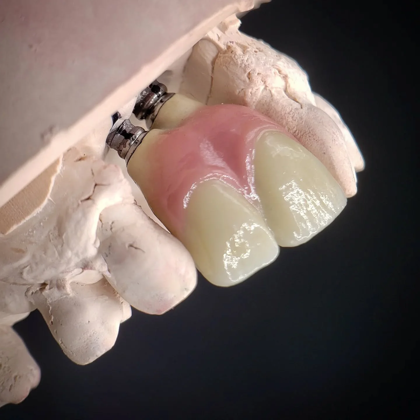 A beautifully realistic screw-retained anterior PFZ bridge, with gum porcelain in a G4 shade.