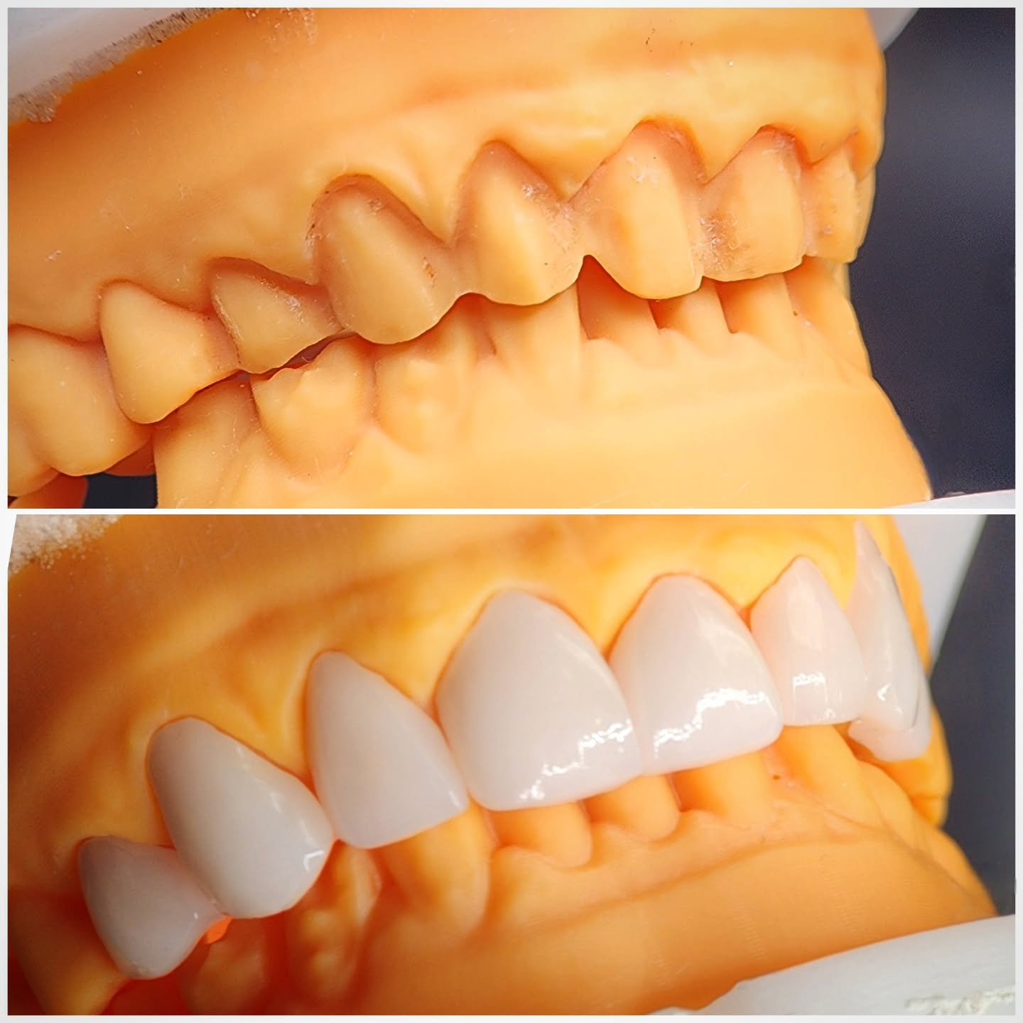 A set of 8 e.Max veneers, in an ultra-white BL1 shade, for a client in County Clare. And some lovely prepwork for our technician to work to, as well.