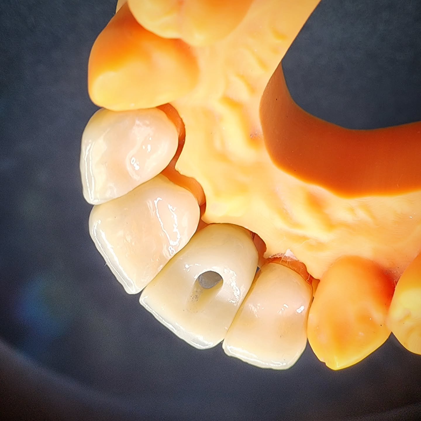 These 4 PFZ anterior crowns, one screw-retained to an implant, were sent to a client in Waterford this week.